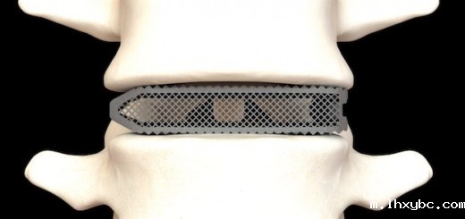 Osseus Fusion SYstem 2